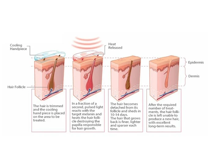 808 Diode Laser Hair Removal Machine 808 Diode Laser Hair Removal Machine