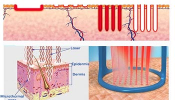 Dot Matrix Laser Cosmetic Technology