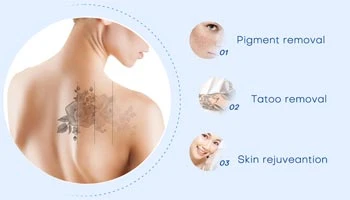 Application Scope Of Laser Beauty