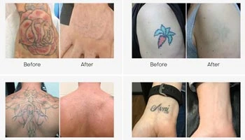 Tattoo Removal Business: Your Path To Profitable Distribution