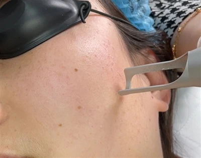 Which Laser Machine Is Best For Tattoo Removal
