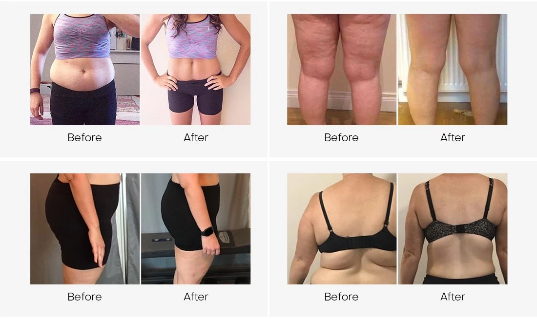 laser fat reduction machine 6