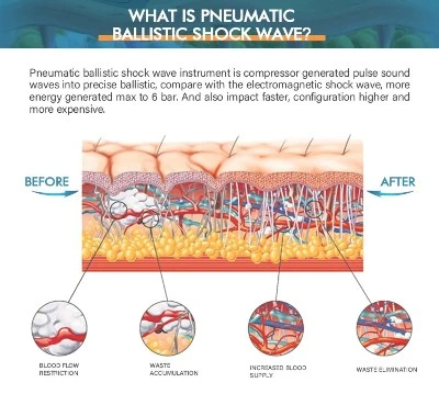 Shockwave Treatment For Shoulder Pain Shockwave Treatment For Shoulder Pain