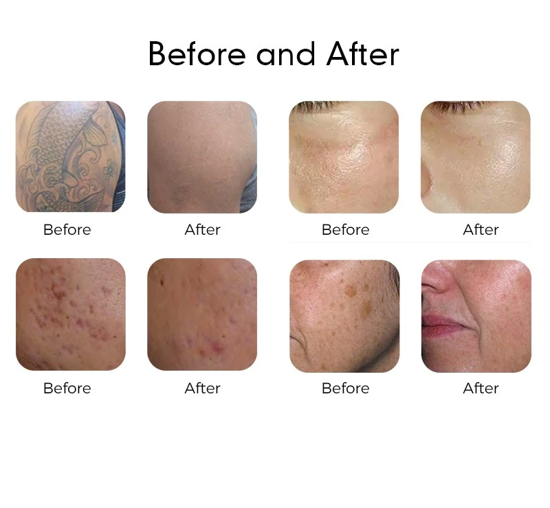 https://www.hbnewangie.com/laser-tattoo-removal-machine/high-quality-pigment-removal-laser-machine.html https://www.hbnewangie.com/laser-tattoo-removal-machine/high-quality-pigment-removal-laser-machine.html