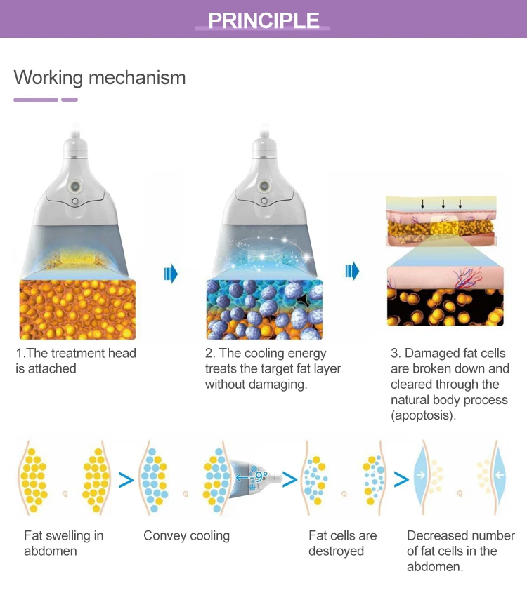 cryo slimming before and after cryo slimming before and after
