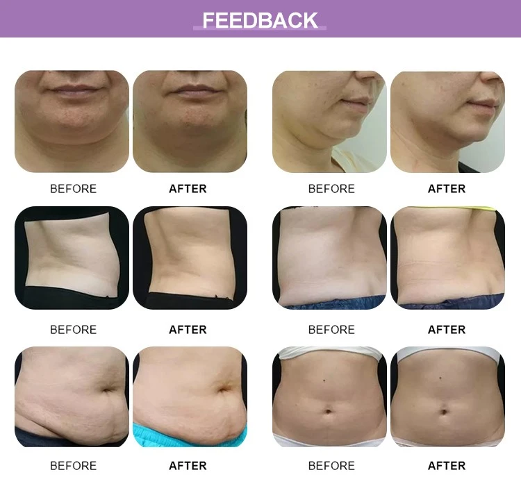 cryo slimming before and after cryo slimming before and after