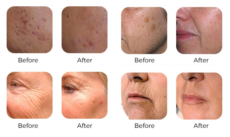 How Long To Recover From Laser Skin Resurfacing
