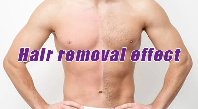 The Effectiveness Of High Power Diode Laser Hair Removal