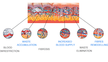 Extracorporeal Shock Wave Therapy For Cellulite