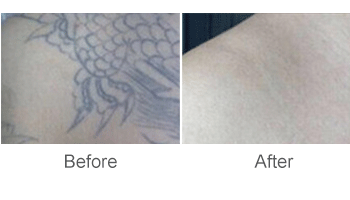 What Laser Tattoo Removal Has The Best Results