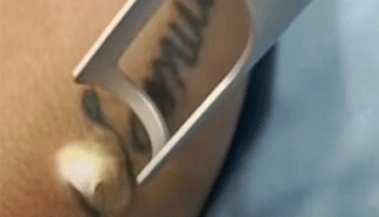 How Do I Become A Tattoo Removal Technician in The UK