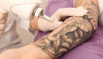 Is Nd:YAG Good For Tattoo Removal