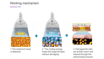 How Does Fat Leave The Body After Fat Freezing