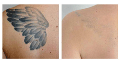 ND YAG Laser Tattoo Removal Before And After