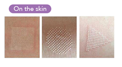 Co2 Fractional Laser Facial Treatment