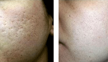 Co2 Ablative Laser For Skin Resurfacing