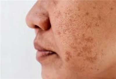 Laser Treatment For Dark Spots