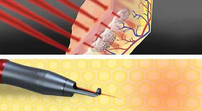 How Laser Tattoo Removal Works