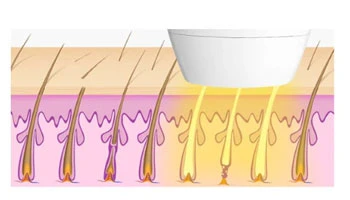 At-Home Vs. Professional Laser Hair Removal