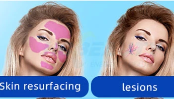 Laser Skin Rejuvenation For Anti-Aging: Does It Really Work