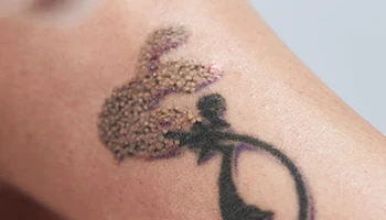 Does Laser Tattoo Removal Leave Scars