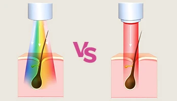 How To Choose Between IPL And Diode Laser Hair Removal