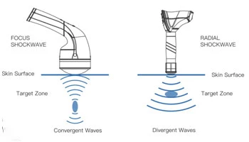Radial Vs. Focused Shockwave