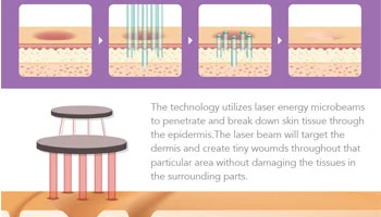 Fractional CO2 Laser Machine: The Ultimate Guide For Clinics And Practitioners