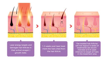 Which Laser Is Best For Permanent Hair Removal?