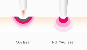 CO2 Lasers Vs. Er:YAG Lasers Compared