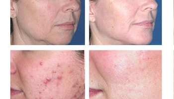 Micro Needling Radio Frequency Before And After