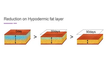 Non Invasive Body Contouring Treatments