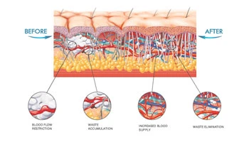 How Does Shock Wave Therapy Work