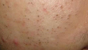 How To Get Rid Of Dark Spots On Face