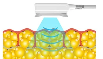 Does Cryo Slimming Really Work