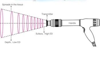 Shockwave Therapy Gains Global Attention