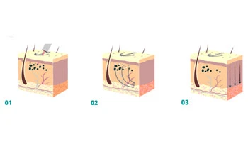 How Laser Tattoo Removal Works: A Step-by-Step Guide