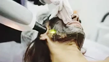 Laser Tattoo Removal Machine Price Uk