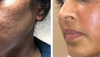 Who Should Not Do RF Microneedling?