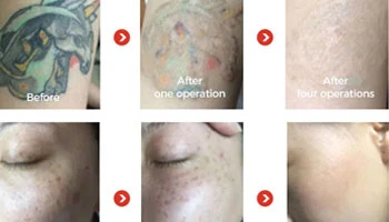 How Expensive Is Laser Tattoo Removal in Canada