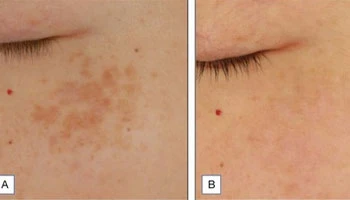 The Science Behind 1927nm Thulium Laser For Skin Rejuvenation
