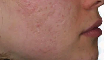 How Much Does Laser Skin Rejuvenation Cost