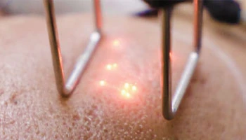 What Is The Cost Of Fractional CO2 Laser Treatment