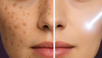 How Long Does Pigmentation Take To Fade After Laser