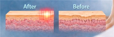Is Laser Skin Tightening Permanent