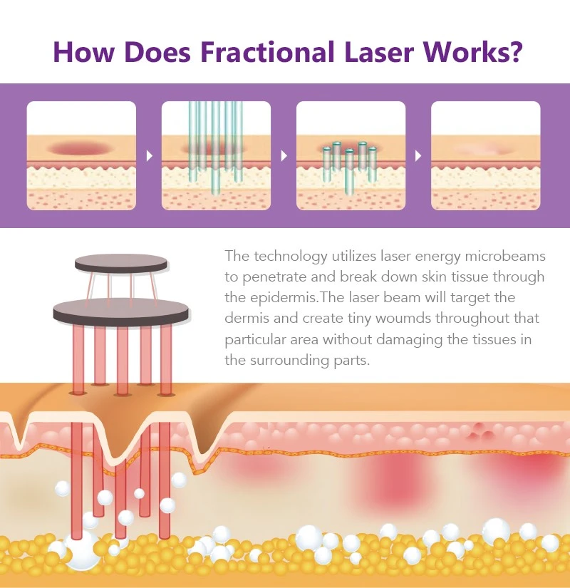 fractional co2 laser machine for sale fractional co2 laser machine for sale