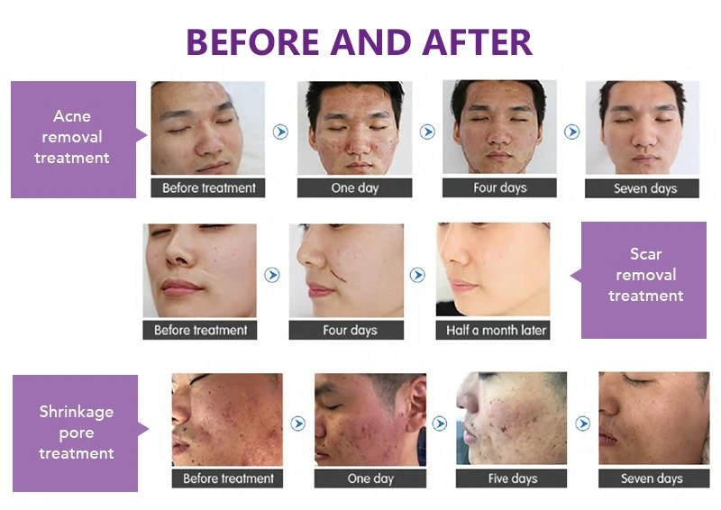 fractional co2 laser machine for sale