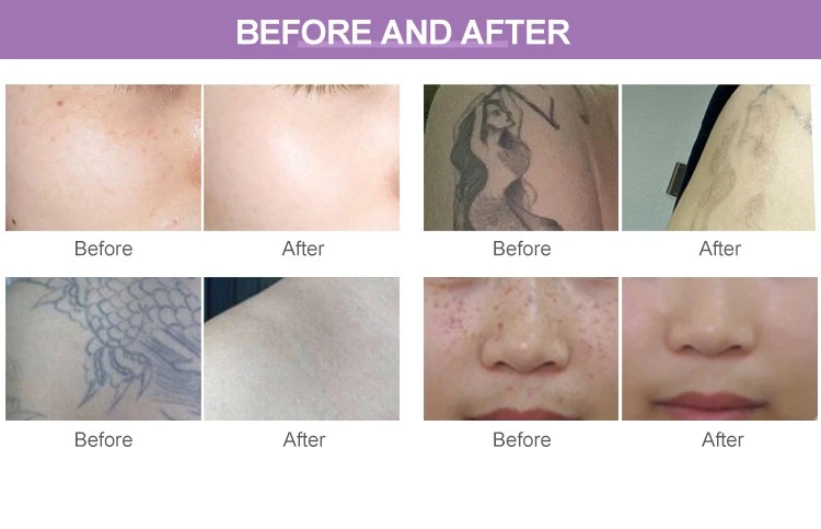 Laser Machine To Remove Tattoo Laser Machine To Remove Tattoo