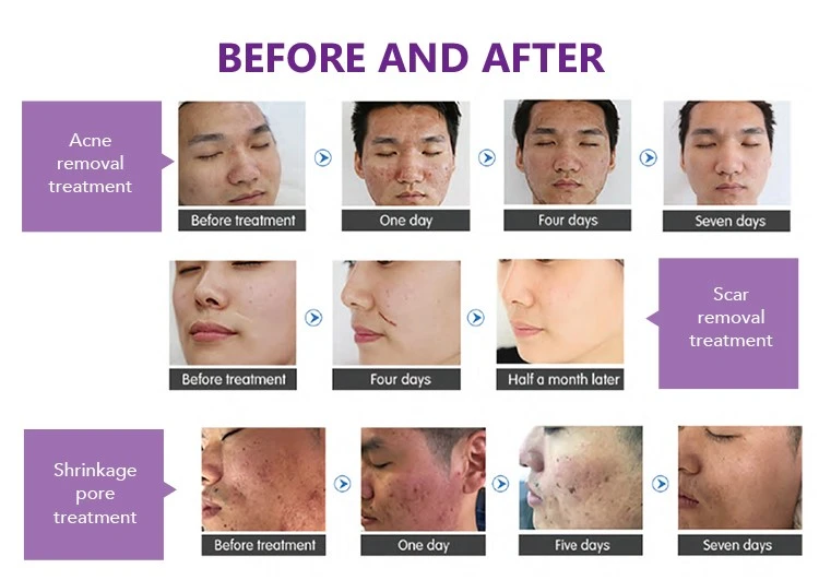 Co2 Fractional Laser Equipment Co2 Fractional Laser Equipment