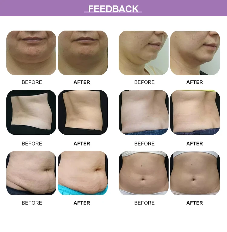 Freeze Fat Removal Machine